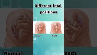 DIFFERENT FETAL POSITIONS IN THE WOMBdifferent fetal positions [upl. by Hurty]