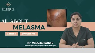 Melasma pigmentation Explained by the Skin Doctor [upl. by Ynomrah652]