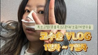 코수술 VLOG 코수술 1일차부터 7일차까지ㅣ복코수술ㅣ복코축소ㅣ코끝ㅣ콧대ㅣ비염수술 [upl. by Alyce]