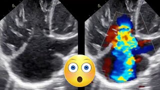 Post Tetralogy of Fallot repair echocardiography TOF [upl. by Aetnahc]