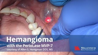 Hemangioma treatment with the PerioLase MVP7 [upl. by Sanyu541]