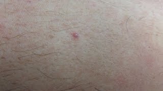 Encapsulated Ingrown Hairs [upl. by Grimonia]