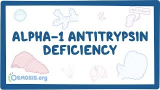 Alpha1 Antitrypsin Deficiency  causes symptoms diagnosis treatment pathology [upl. by Reywas]