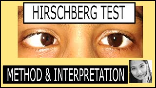 Hirschberg Test Explained Squint simplified for medical students [upl. by Revart]