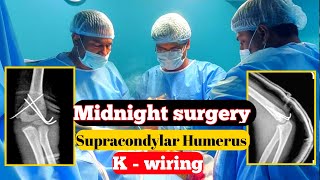 Vlog 5  We Performed Surgery On A Broken Elbow At Midnight doctor hospital vlogs [upl. by Stephenie4]