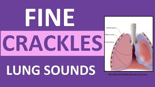 Crackles Fine Lung Sounds  Crackles and Rales Breath Sounds Abnormal [upl. by Assyle]