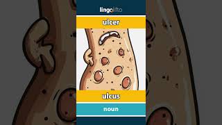 🇬🇧🇸🇪 ulcer  ulcus  vocabulary builder  learn English  låt oss lära oss engelska [upl. by Zacek592]