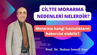 Ciltte Morarma Nedenleri Nelerdir  Hangi Rahatsızlıklar Morarmaya Neden Olur [upl. by Leihcim]