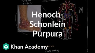 HenochSchonlein purpura  Circulatory System and Disease  NCLEXRN  Khan Academy [upl. by Sinnej]