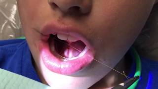 Functional frenuloplasty updated technique with lingual palatal suction [upl. by Atlante]