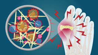 Gout What you need to know [upl. by Ennaimaj373]