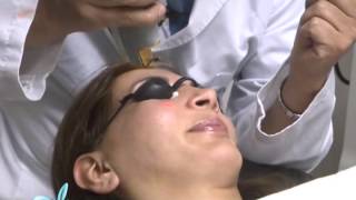 Tratamiento de la Rosacea con Laser DR LUIS EDUARDO MARTINEZ CLINILASER [upl. by Acinor]