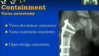 Perthes Disease [upl. by Yruam]