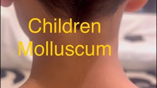 Children Molluscum treatment Don’t worry Just Don’t manipulate and scratch or cryo or acid [upl. by Dinesh887]