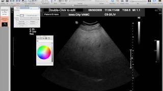 Fixing ID with Osirix [upl. by Ttenaj]