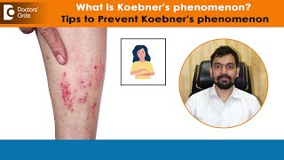 After Skin InjuiryKOEBNERS or ISOMORPHIC Phenomenon amp PreventionDrRajdeep MysoreDoctors Circle [upl. by Verlee]