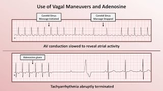 Intro to EKG Interpretation  How to Identify Any Tachyarrhythmia with 6 Easy Questions [upl. by Wrench]