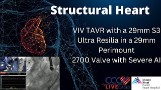 VIV TAVR with a 29mm S3 Ultra Resilia in a 29mm Perimount2700 Valve with Severe AI [upl. by Shiverick]