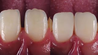 Diastema Closure using composite diastema [upl. by Yesnyl913]