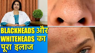 कील और सफ़ेद दानों का पूरा इलाज  Complete and Safe Treatment for Blackheads amp Whiteheads [upl. by Yelraf]