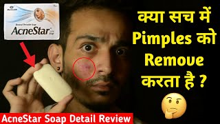 क्या AcneStar Soap सच में Acne Pimples को Remove करता है  Detail Review Uses Benefit Side Effect [upl. by Karb]