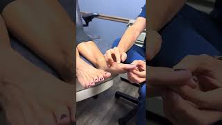 Custom foot orthotics for Hallux limitusrigidus with Stewart at Timonium Foot and Ankle Center [upl. by Ecyned]