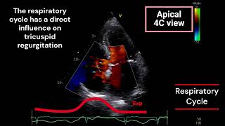 Tricuspid Regurgitation and Respiratory Cycle [upl. by Mosier]