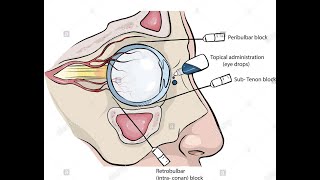 Peribulbar and retrobulbar Block for eye surgery [upl. by Beasley]