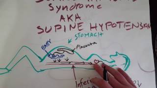 EMT Supine Hypotension  EMT MADE EASY [upl. by Fiester655]