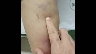 Erythema Nodosum [upl. by Malvie]