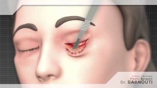 Cosmetic Surgery Animated Video  Eyelid Surgery [upl. by Jaimie]