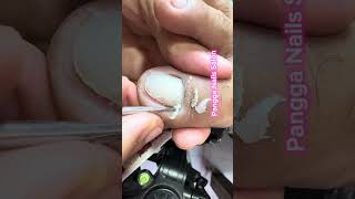 Ingrown and dry skin removal [upl. by Nanahs28]