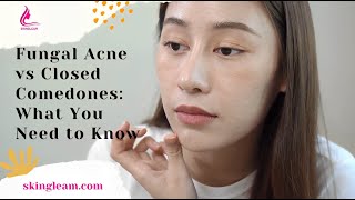 Fungal Acne vs Closed Comedones What You Need to Know [upl. by Lynne700]