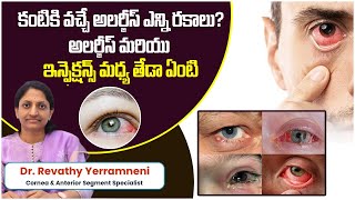 Conjunctivitis Causes Symptoms and Treatment  Types of Eye Infections  Smart Vision Eye Hospital [upl. by Tiffani]