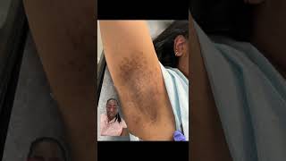 Laser Hair Removal Burn in Dark Skin woman [upl. by Aehcsrop]