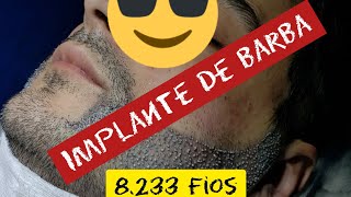 IMPLANTE DE BARBA NATURAL 8322 FIOS [upl. by Ahsieken]