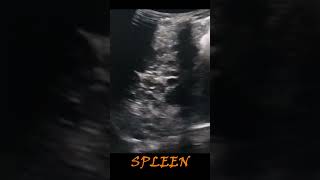 Spleen … what’s the possible diagnosis conclusion ultrasoundscans [upl. by Karina]