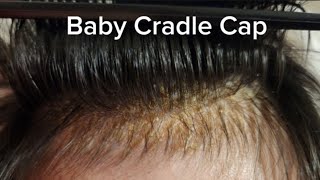 Cradle Cap Removal [upl. by Acissej777]