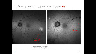 Best practices for utilizing FAF amp UWF retinal imaging in the optometric practice [upl. by Horbal]