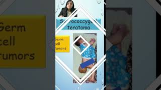 Sacrococcygeal Teratoma in newborn  Image based Diagnosis OSCE Spot Diagnosis  Shorts [upl. by Vinita83]