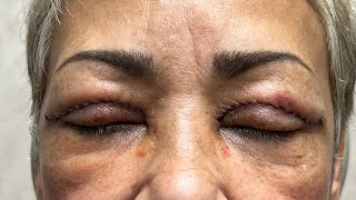 Blepharoplasty Eyelid Surgery Stitches Removal  1 Aesthetic Plastic Surgery [upl. by Bowyer]