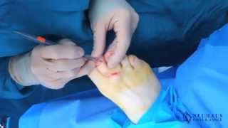 Cyst Removal Surgery Performed by Dr Matthew Neuhaus [upl. by Berner102]