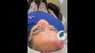 Co2 laser hyperplasia sebaceous co2laser blackheads extractionsatisfaction [upl. by Acker935]