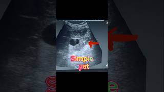 Simple Renal Cyst  Cortical Cyst  Kidney Cyst on Ultrasound [upl. by Jamaal]