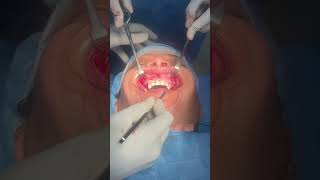 Anterior Maxillary Osteotomy [upl. by Calandria]