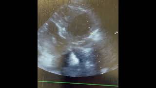 anesthesiology echocardiography ultrasound [upl. by Irma]