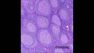 Florid follicular lymphoid hyperplasia [upl. by Melliw]