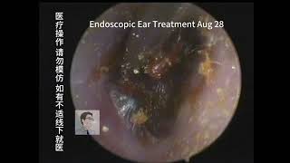 Ear wax removalchildrens cerumen embolism cleaning 20230828 [upl. by Jegger317]