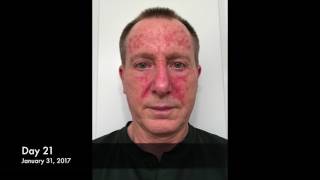 Actinic Keratosis Fluorouracil Treatment 27Day Time Lapse [upl. by Aliet]