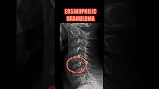 Eosinophilic Granuloma bones radiology doctor [upl. by Derian]